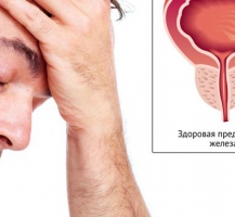 ДГПЖ (аденома)